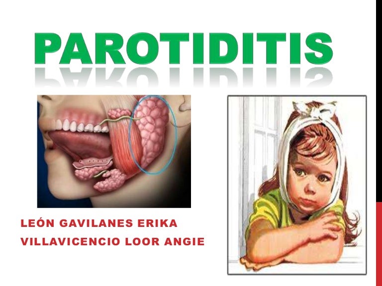 Parotiditis causas y prevencion